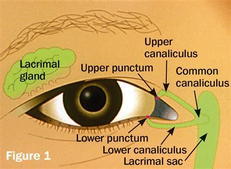 Community Eye Health Journal » Lacrimal syringing