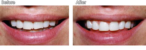 Tooth Colored Fillings Gallery - Dr. Jack M. Hosner, D.D.S.