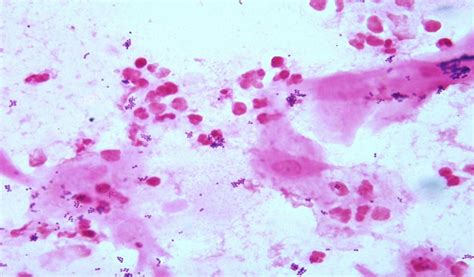 Gram stain of wound specimen | Medical Laboratories