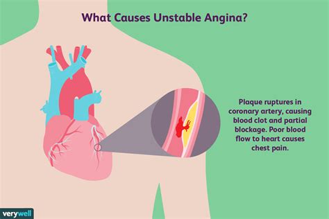 Stable Angina Vs Unstable Angina Ecg : Unstable Angina Pathophysiology ...