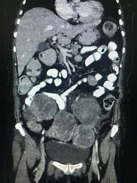 leiomyomatosis