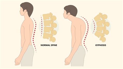 Understanding Dowager’s Hump: Causes, Symptoms, And Risk Factors ...