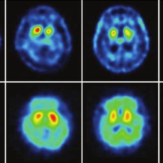 (PDF) Recent Advances in Imaging of Dopaminergic Neurons for Evaluation of Neuropsychiatric ...