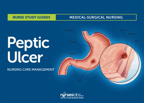 Peptic Ulcer Disease Nursing Care and Management - Nurseslabs