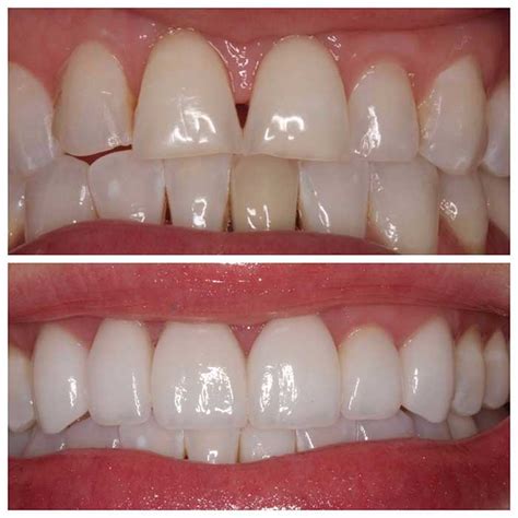 What Are Veneers? | Germantown Advanced Dentistry