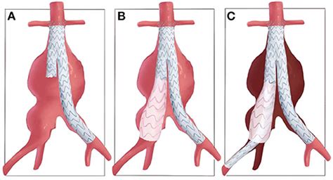 Frontiers | Application of a Novel Common-Iliac-Artery Skirt Technology (CST) in Treating ...