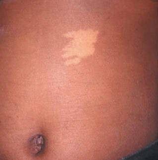 White Spots: Symptoms, Causes and Treatments, | Digest Ground