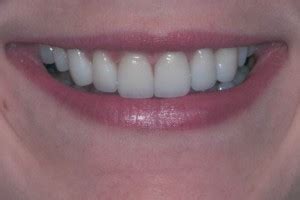 Dentist Before After Gallery, Family and Cosmetic Dentistry in 85716