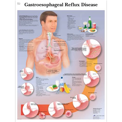 Human Female Reflux Anatomy Chart