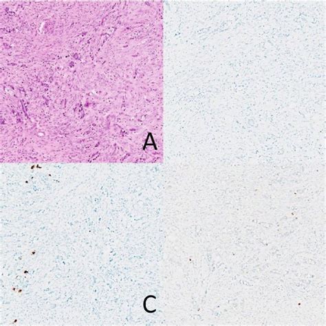 Primary Adenocarcinoma Ex-Goblet Cell Carcinoid Results (N = 21 ...