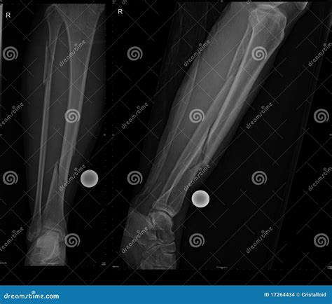 Fracture fibula - daQas