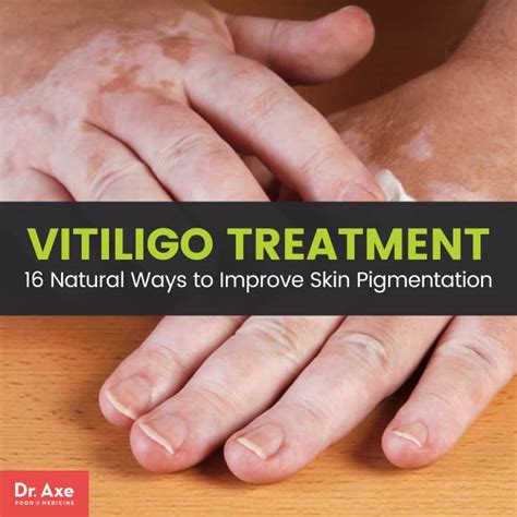 Vitiligo Treatment: 16 Natural Ways to Improve Pigmentation | Best Pure Essential Oils