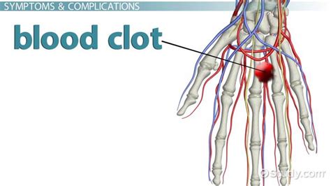 Blood Clot in the Hand: Symptoms, Signs & Treatment - Lesson | Study.com