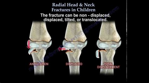 Radial Head & Neck Fractures In Children - Everything You Need To Know ...