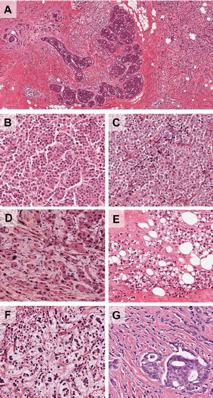 Morphological characteristics of invasive lobular carcinoma and its ...