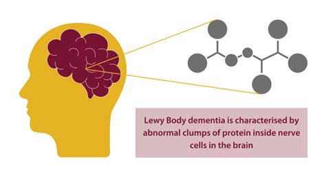 Lewy Body dementia - RICE