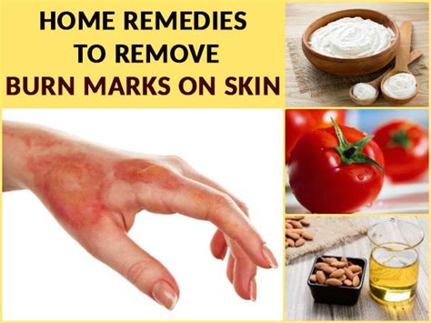 Home Remedies To Remove Burn Marks On Skin - Boldsky.com