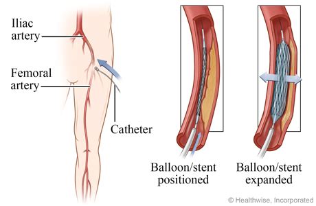 Peripheral Arterial Angioplasty | Michigan Medicine