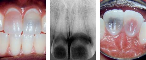 42 Tooth Resorption | Pocket Dentistry