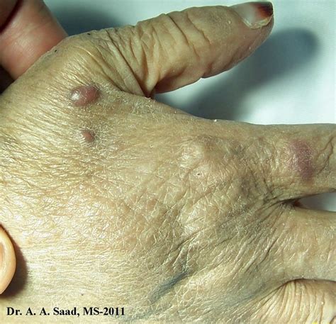 Kaposi Sarcoma (classic type) - dermRounds Dermatology Network