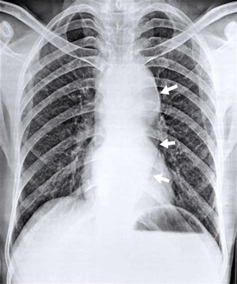 Cureus | Cardiovocal Syndrome Secondary to Thoracic Aortic Aneurysm: An ...