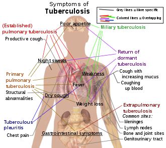 Tuberkulosis - Wikipedia, ang malayang ensiklopedya