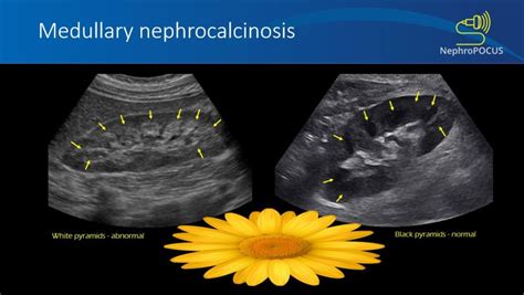 Medullary nephrocalcinosis – NephroPOCUS