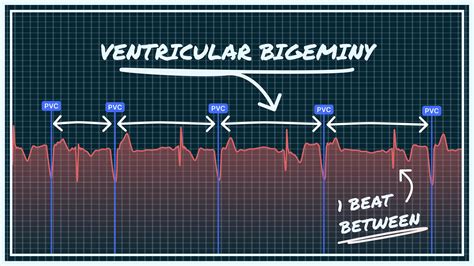 What Ventricular Bigeminy Looks Like on Your Watch ECG | Qaly