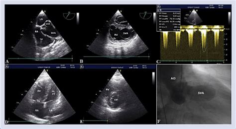 Transoesophageal echocardiography demonstrating a large right sinus of ...