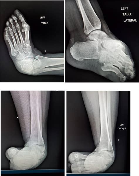 Conversion disorder and the complete resolution of a spastic equinovarus deformity with ...