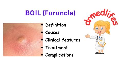 Boil furuncle definition causes clinical features treatment ...