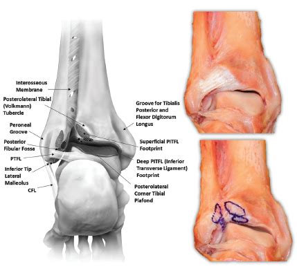 Anatomy 101: Ankle Syndesmosis - Distal Tibiofibular Joint — Rayner & Smale