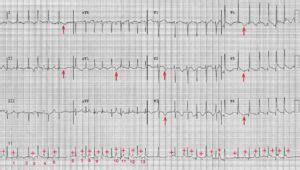 ECG Case 129: Multifocal Atrial Tachycardia (MAT) - Manual of Medicine