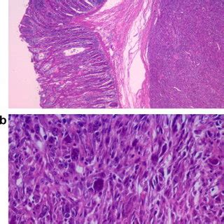 Original right breast phyllodes tumor histology. (A) Photomicrograph... | Download Scientific ...