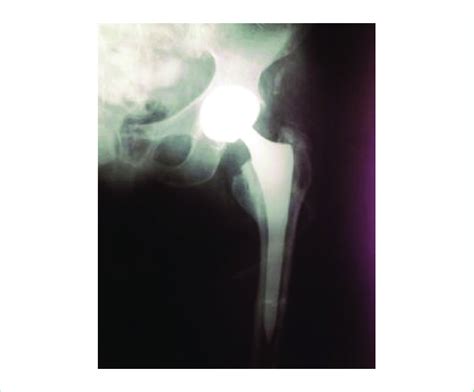 Left Total Hip Arthroplasty 5 years post operatively. | Download Scientific Diagram