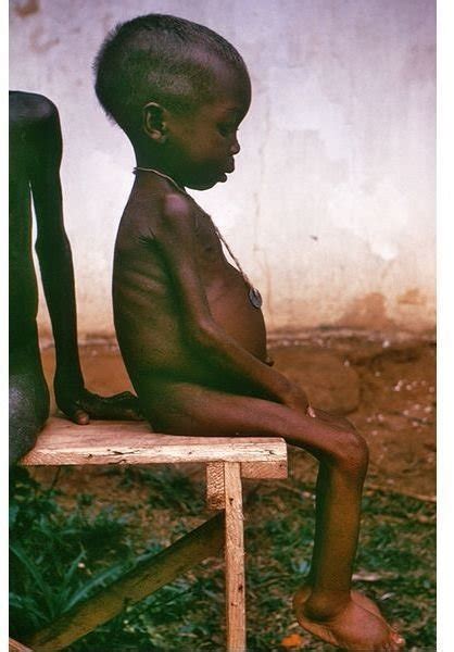 The Effects of Starvation: Facts on How Inadequate Nutrition Affects the Body