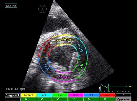 Right parasternal short-axis view at papillary muscle level for 2DST ...