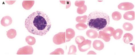 Pseudo–Pelger-Huët anomaly in a patient on tacrolimus