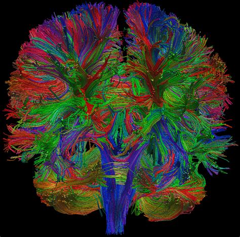 Diffusion Tensor Imaging (DTI) of human brain | Human brain, Brain diseases, Brain art