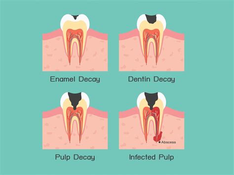 Can root canal stop tooth decay and save your teeth?