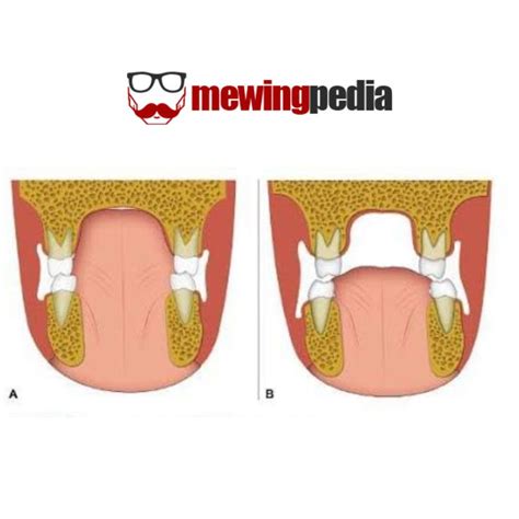 Mewing Tongue Posture: How to Mew | Postures, Tongue, The incredibles