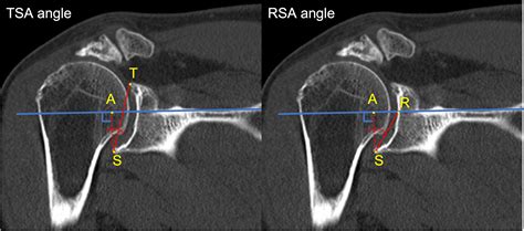 The Reverse Shoulder Arthroplasty Angle in MRI: Impact of the Articular Cartilage in the ...