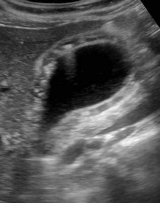 Abdomen and retroperitoneum | 1.2 Gallbladder and bile ducts : Case 1.2.10 Gallbladder ...