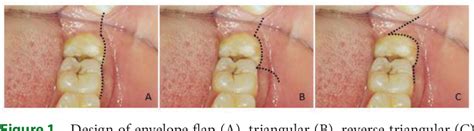 Figure 1 from Comparison of three flap designs on postoperative ...