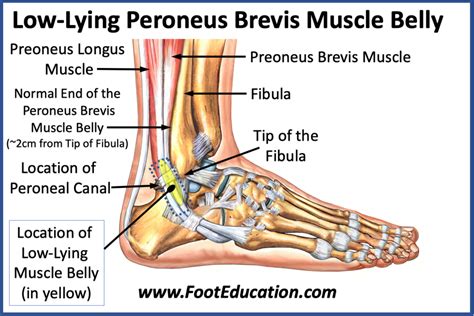 Low-Lying Peroneus Brevis Muscle Belly - Peroneus Quartus Muscle - FootEducation