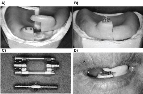 Impression Techniques for Microstomia Patients: No longer Cumbersome - A Review | Dentistry and ...