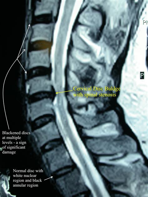 Cervical Herniated Disc | Sport and Spine Rehab Clinic | Maryland, Virginia, DC