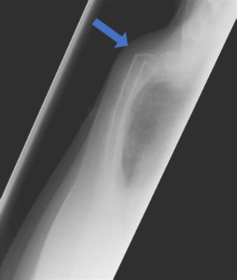 Sternal Fracture