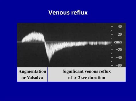 Doppler ultrasound of normal venous flow