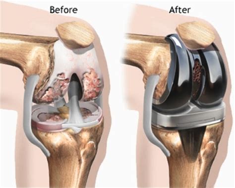 Knee Replacement Surgery : Types, Procedure, Cost & Replacement Alternatives » How To Relief